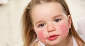 Why Are There So Many Allergies?